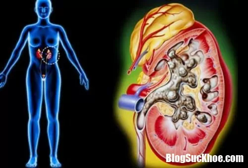 Những tác hại nguy hiểm của bệnh viêm cầu thận