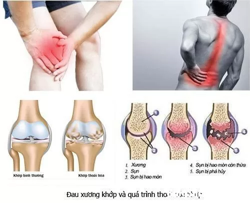 Nguyên nhân và triệu chứng của bệnh xương khớp
