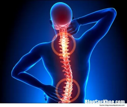 Phương pháp điều trị bệnh gai cột sống hiệu quả nhất