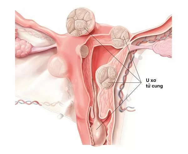 Những dấu hiệu cảnh báo bệnh phụ khoa nguy hiểm