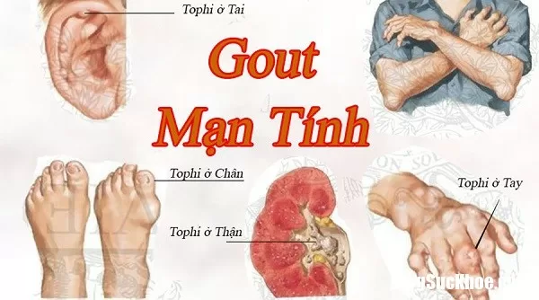 Nguyên nhân và cách chữa bệnh gout