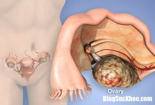 Một số dấu hiệu sớm của ung thư buồng trứng
