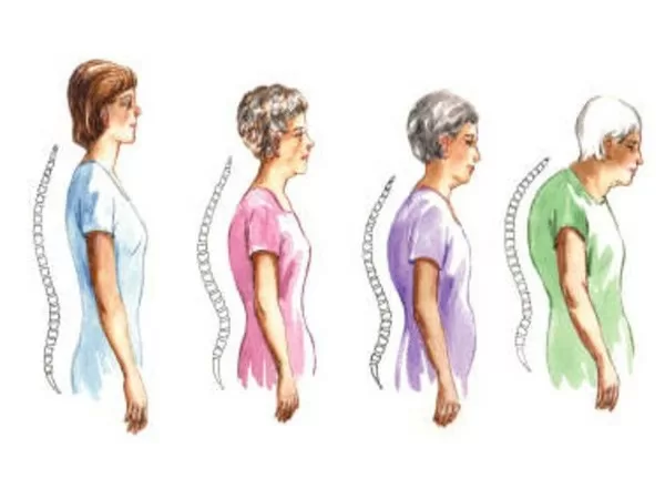 Những việc cần làm để phòng chống loãng xương cho chị em