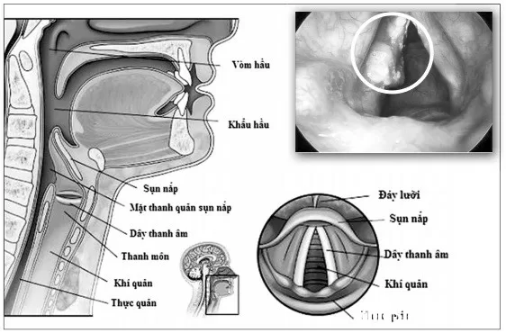 Chớ xem thường khi bị khản tiếng