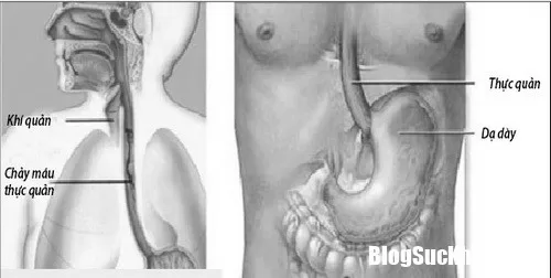 Cách phòng ngừa giãn tĩnh mạch thực quản ở người bệnh gan
