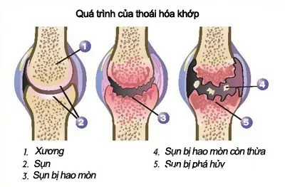 Cải thiện bệnh thoái hóa khớp nhờ thực đơn ăn uống