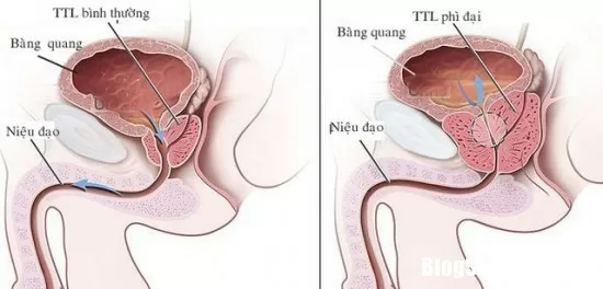 Nguyên nhân và cách phòng trị bệnh tiểu đêm ở người già