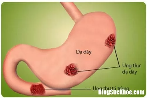Những dấu hiệu sớm nhận biết bệnh ung thư dạ dày