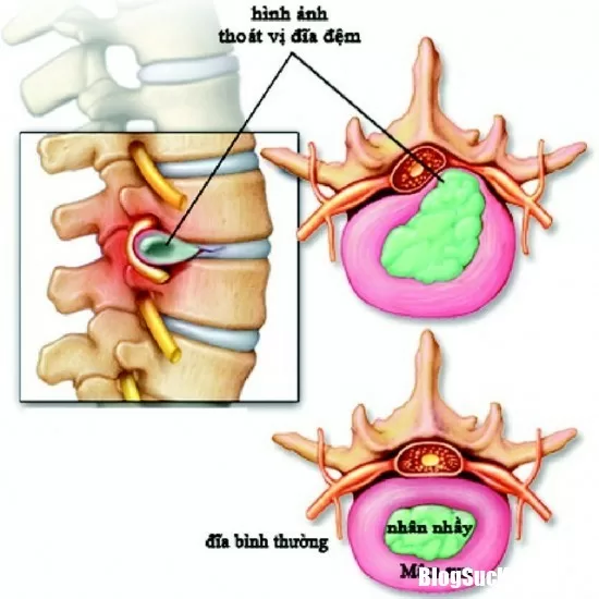 Bệnh thoái hóa đốt sống cổ dễ gây nhiều biến chứng nguy hiểm
