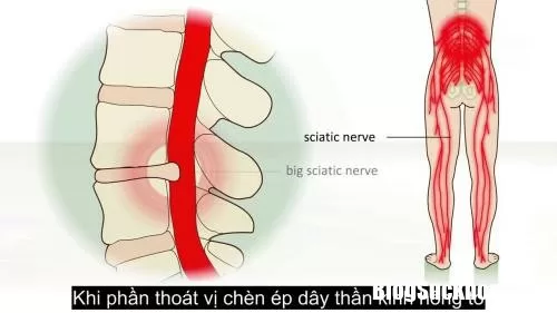 Bệnh đau dây thần kinh tọa có nguy hiểm không ?