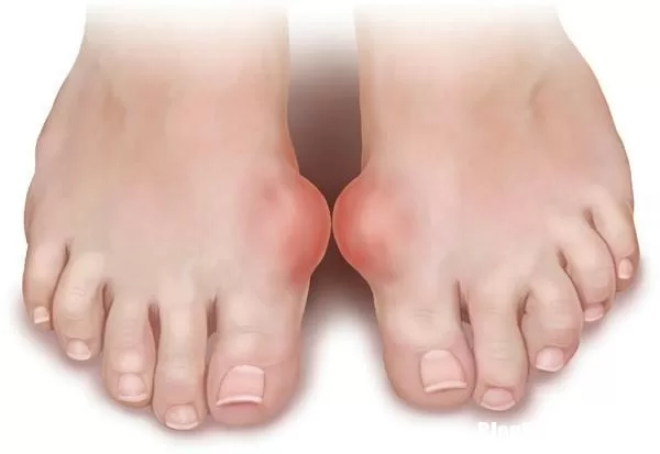 Nguyên nhân và cách phòng ngừa bệnh gút