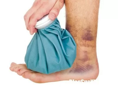 Mẹo đánh bay các vết sưng bầm một cách nhanh chóng