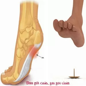 Bệnh gai xương gót chân và cách đề phòng