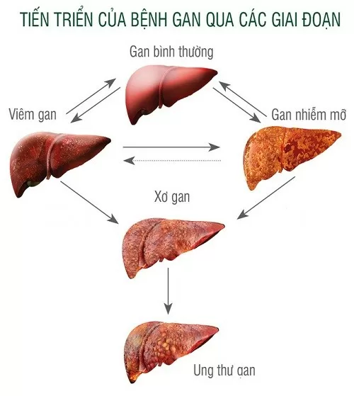 Vì sao bệnh gan nhiễm mỡ có thể chuyển biến thành xơ gan ?