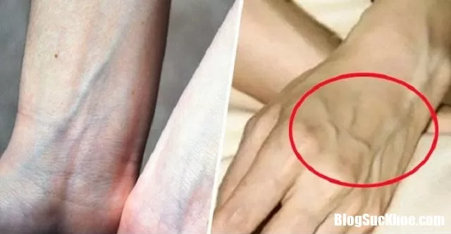 Những vị trí nổi gân xanh cảnh báo bệnh nguy hiểm nên lưu ý