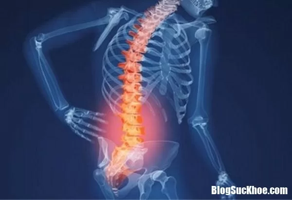 Triệu chứng của bệnh vôi hóa cột sống