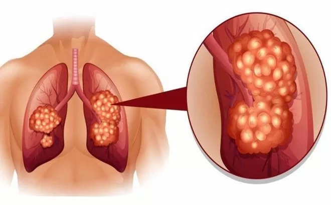Những dấu hiệu dễ nhận biết của ung thư phổi