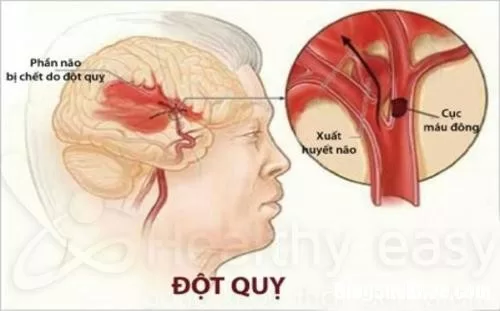 Những biến chứng cực kỳ nguy hiểm của rối loạn nhịp tim