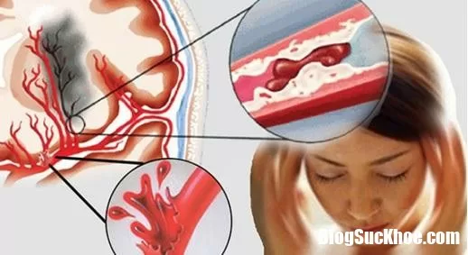Dấu hiệu nhận biết tai biến mạch máu não để cấp cứu sớm