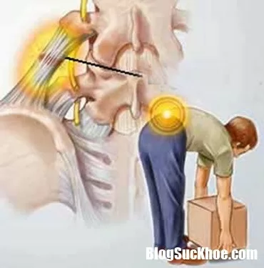 Làm sao để tránh tái phát đau cột sống đau thắt lưng