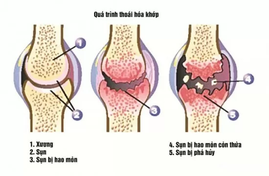 Những phương pháp điều trị thoái hóa khớp gối