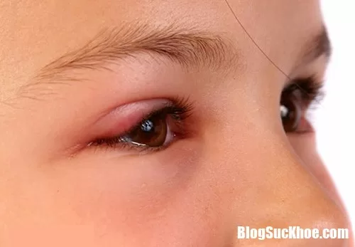 Vì sao mùa xuân người ta thường ngứa mắt