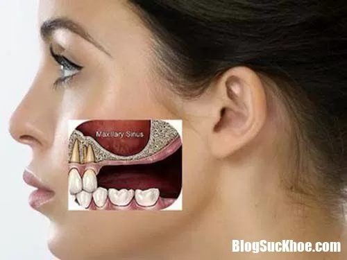 Những phương pháp chữa viêm xoang hàm hiệu quả nhất