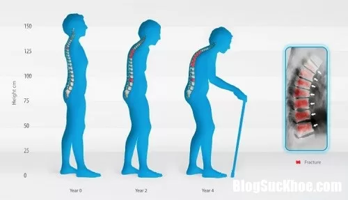 Bệnh loãng xương đem lại những biến chứng nguy hiểm gì ?