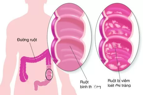 Viêm đại tràng mạn tính bệnh đang rất phổ biến và khó chữa