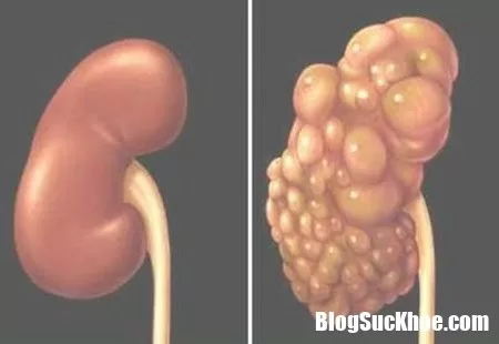 Các biến chứng của bệnh thận đa nang