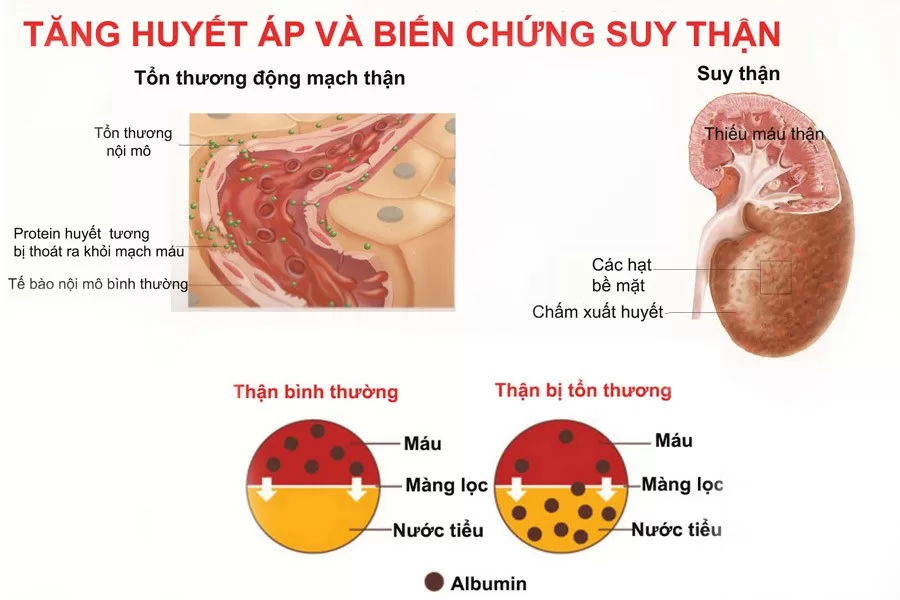 Những biến chứng khó lường do tăng huyết áp gây ra