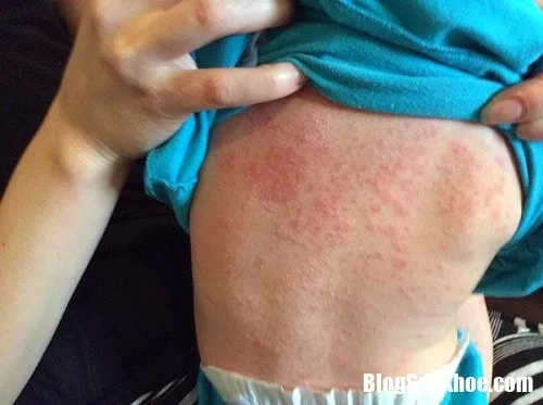 Cách nhận biết và ngăn chặn biến chứng của sởi