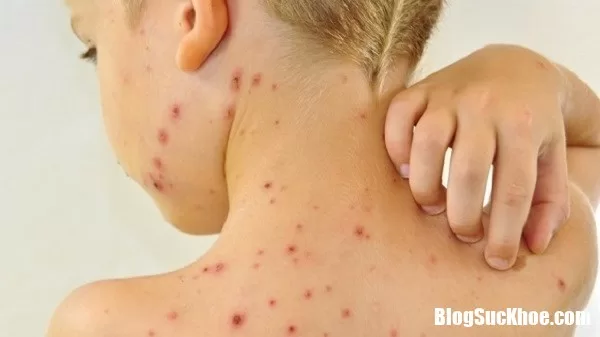 Những thực phẩm người bị thủy đậu tuyệt đối không nên ăn