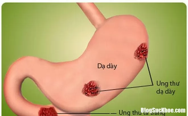 Hai dấu hiệu cho biết chắc chắn bạn đã mắc ung thư dạ dày giai đoạn đầu