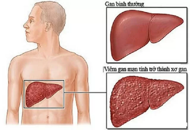 Viêm gan B có nguy hiểm không?