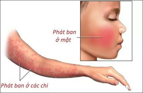 Mùa xuân hè nhớ phòng bệnh ban đỏ nhiễm khuẩn