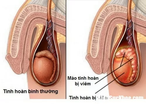 Bệnh quai bị dễ lây lan có nguy cơ thành dịch