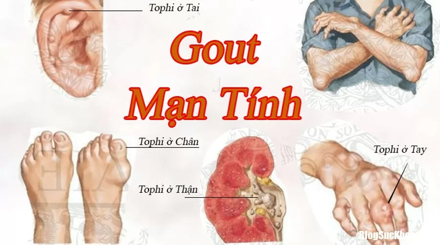 Những biến chứng của bệnh gút và thuốc điều trị