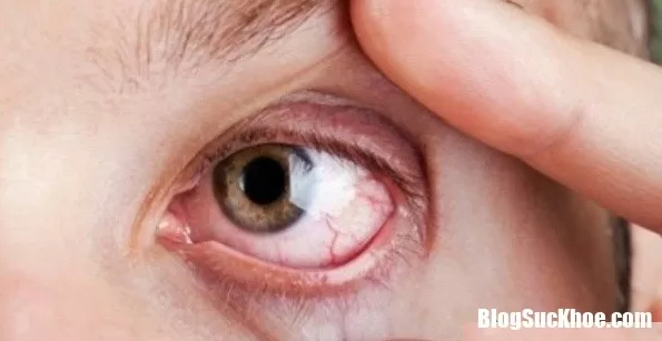 Tìm hiểu về bệnh cườm nước