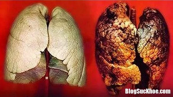 Xét nghiệm máu giúp phát hiện sớm ung thư phổi