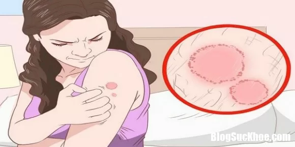 Hiểu rõ hơn về bệnh nấm da để điều trị cho hiệu quả