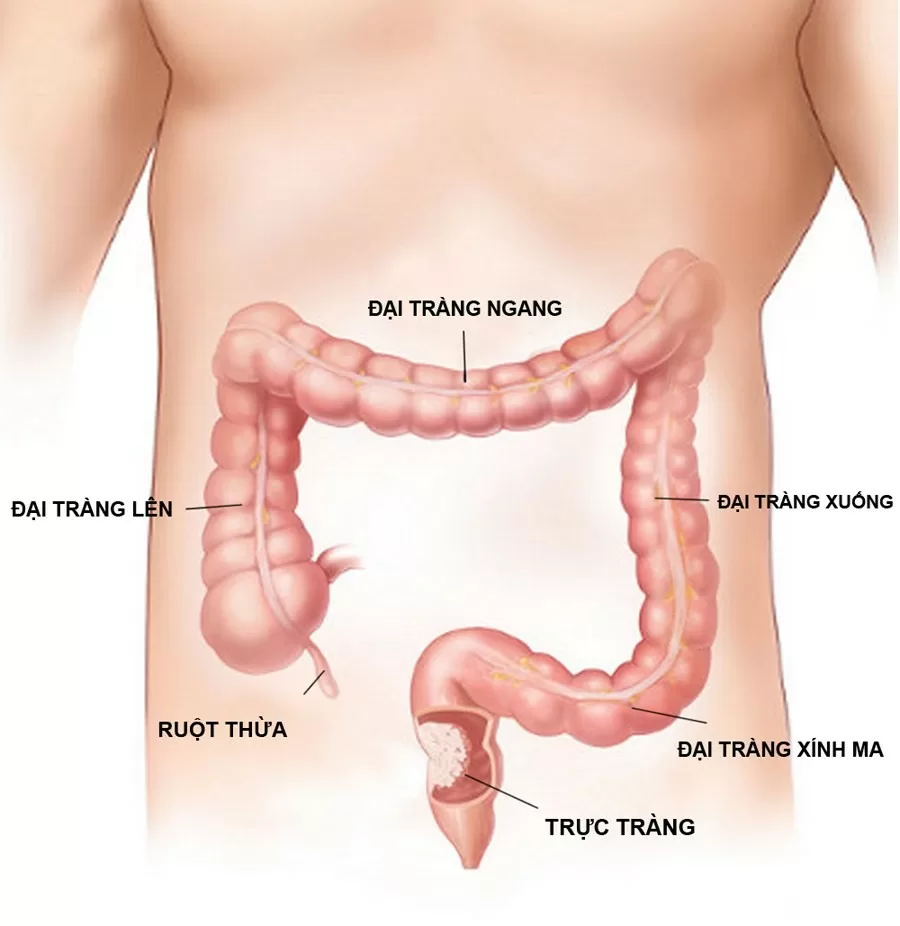 Viêm đại tràng dễ có nguy cơ thành bệnh mạn tính