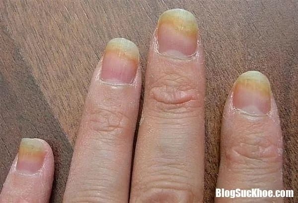 Cách trị và phòng ngừa bệnh nấm móng tay