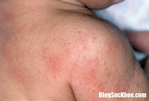 Những bệnh ngoài da thường gặp và cách phòng ngừa hiệu quả