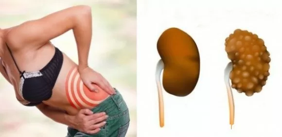 Những thói quen hằng ngày khiến thận bị hỏng