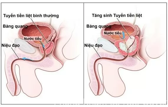 Những yếu tố chính gây nên u xơ tuyến tiền liệt