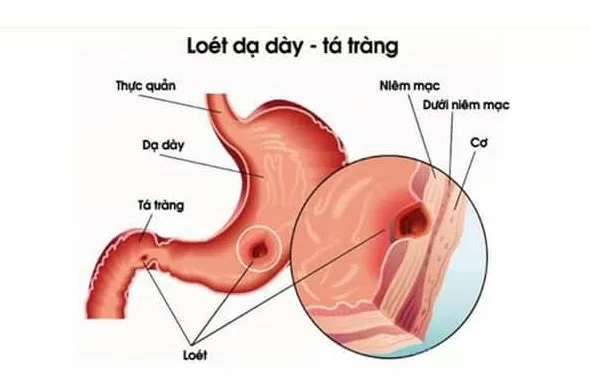 Nguyên nhân và triệu chứng gây viêm loét dạ dày