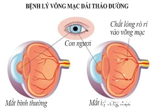 Những biến chứng bệnh về mắt do tiểu đường gây ra