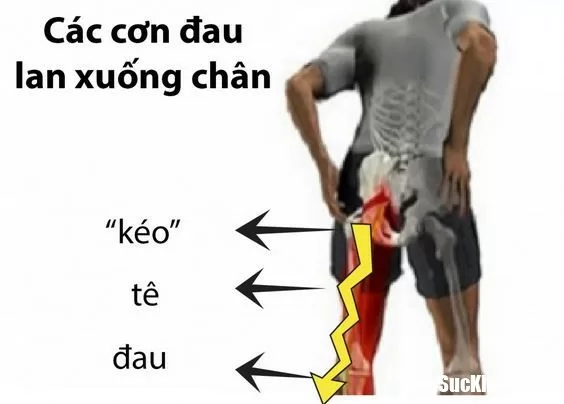 Cần cảnh giác với những dấu hiệu bệnh đau dây thần kinh tọa