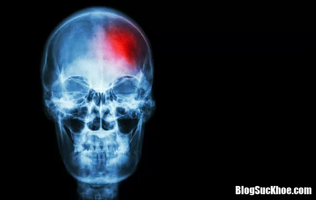 Những dấu hiệu cảnh báo đột quỵ không nên lơ là bỏ qua kẻo tử vong